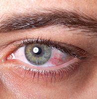 Conjunctivitis