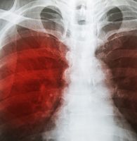 Tuberculosis