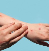 Monkeypox: Emerging Infectious Disease Threats