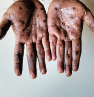 Monkeypox in the Workplace FAQ